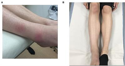 Case Report: Borrelia-DNA Revealed the Cause of Arthritis and Dermatitis During Treatment With Rituximab